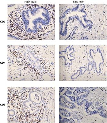 Prognostic Significance of NLR, PLR, LMR and Tumor Infiltrating T Lymphocytes in Patients Undergoing Surgical Resection for Hilar Cholangiocarcinoma